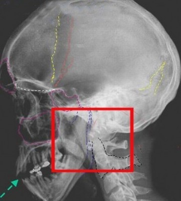 Диагностика переломов основания черепа