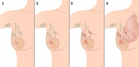 Стадии рака груди (схема)