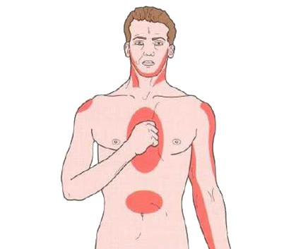Сильная боль в грудной клетке, отдающая в другие, отмеченные на изображении, части тела.