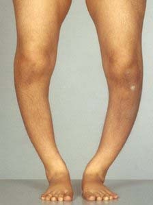 О-образное искривление ног при рахите (фото)