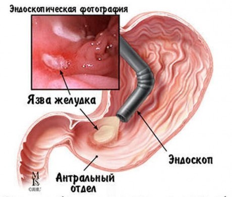 Язва желудка (рисунок и эндоскопическая фотография)