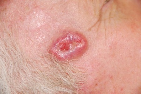 Базально-клеточный рак кожи (фото)