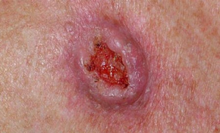 Плоскоклеточный рак кожи (фото)