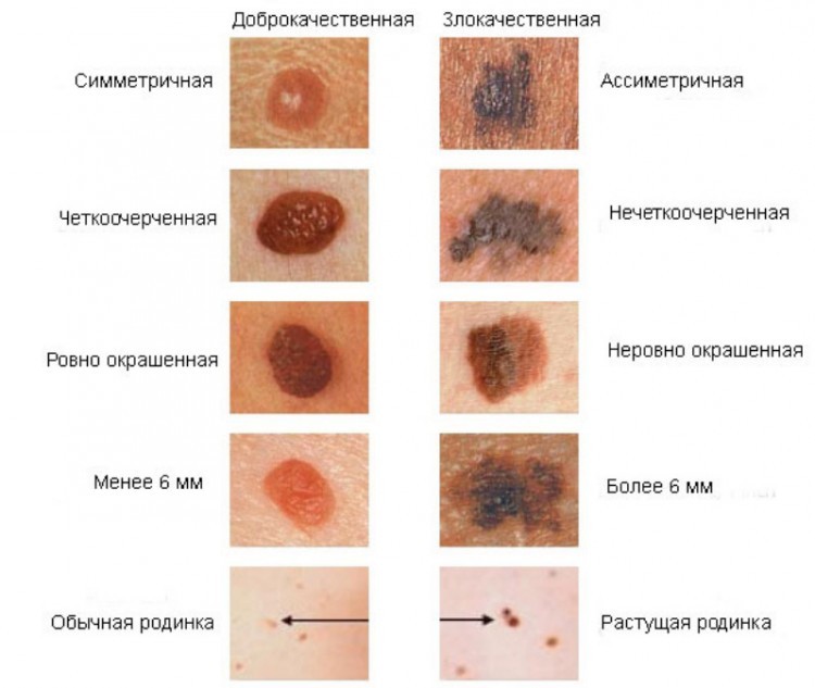 Признаки рака кожи (меланомы) фото