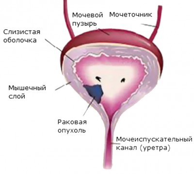  Рак мочевого пузыря (схема)