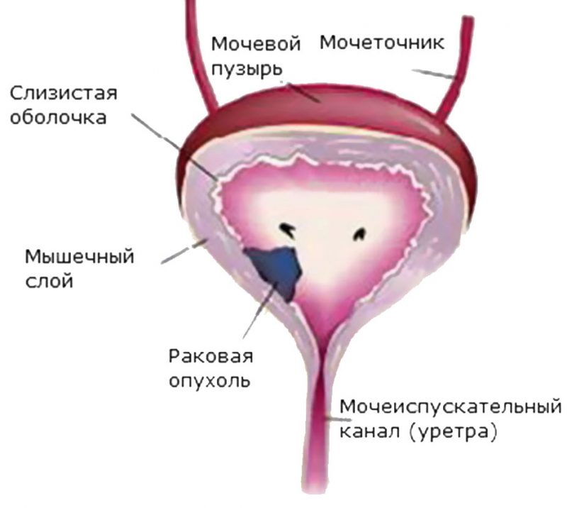 Лечение рака мочевого пузыря у мужчин. Объемное образование мочевого пузыря. Опухоль мочевого пузыря. Злокачественные новообразования мочевого пузыря. Опухоль мочевого пузыря у женщин.