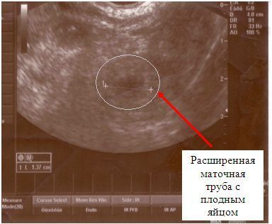 Снимок узи с правосторонней трубной внематочной беременностью