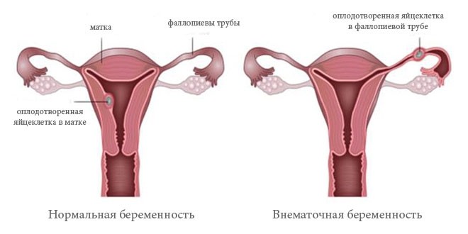 Сравнение нормальной  и трубной внематочной беременностей.