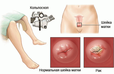 Кольпоскопия – один из методов диагностики рака шейки матки