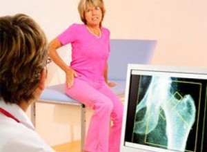 Остеопороз: симптомы, факторы риска, профилактика и лечение. Как избежать ломкости костей?