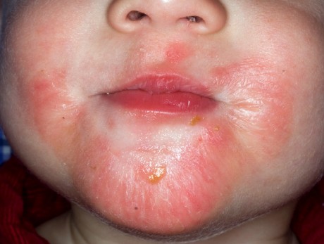 Атопический дерматит у ребенка (фото)