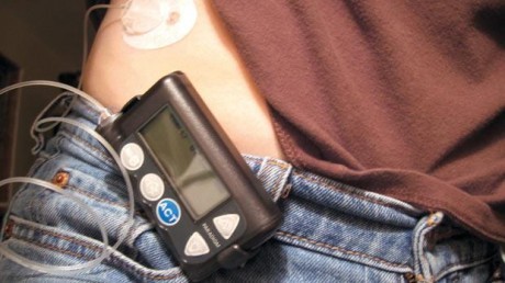 Инсулиновая помпа