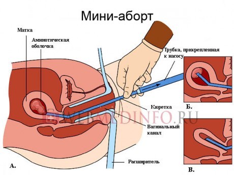 Как проводится мини-аборт
