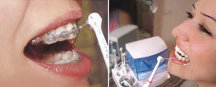 Чистка зубов с помощью ирригатора для полости рта