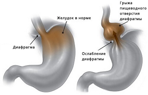 Грыжа пищеводного отверстия диафрагмы: симптомы и лечение
