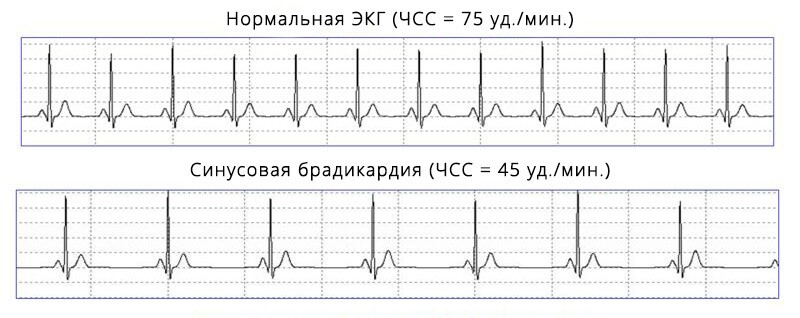 Что такое sin брадикардия