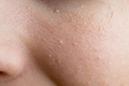 Жировики (липома) на лице: причины, виды лечение